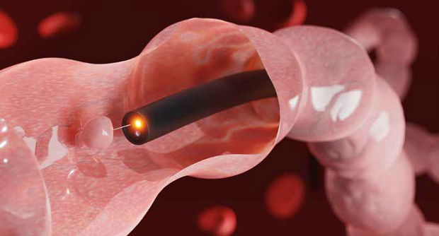 Colonoscopy Singapore: Detecting and Removing Colon Polyps Early